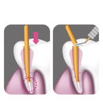 Gutta Percha Cutter - Image 2